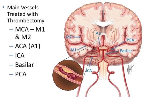 Diagram of brain arteries affected by strokes